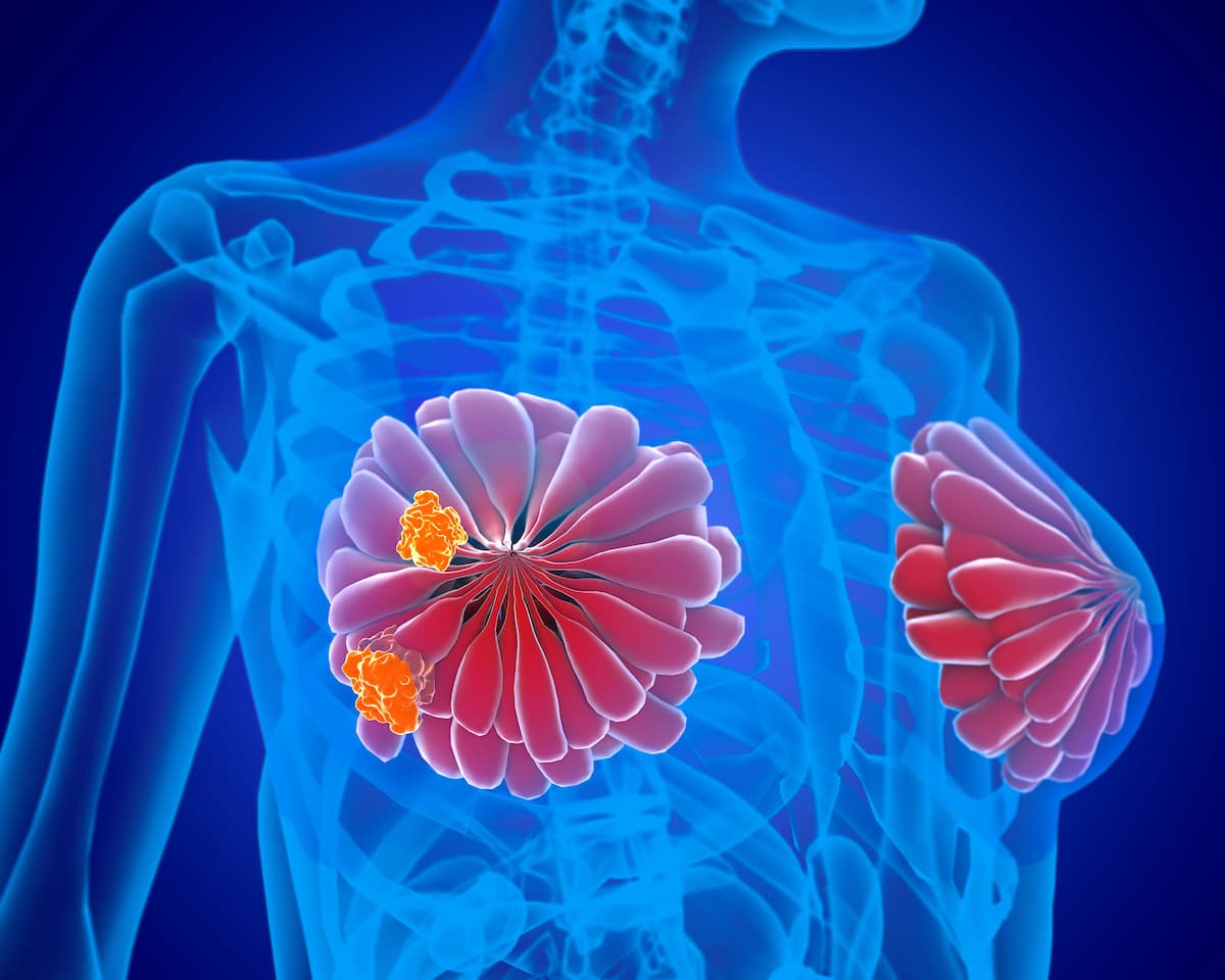 DESTINY-Breast09: T-DXd Plus Pertuzumab Leads in HER2+