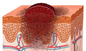 Challenges Abound With Immunotherapy Biomarkers