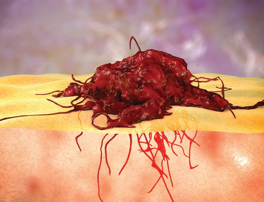 La combinación TILT-123/TIL parece segura y factible en el tratamiento del melanoma metastásico La combinación TILT-123/TIL parece segura y factible en el tratamiento del melanoma metastásico