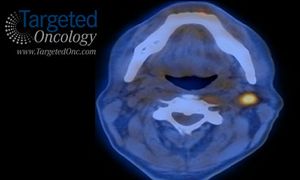 Women Receiving Chemoradiotherapy for Cervical Cancer Achieve Emesis Control With Fosaprepitant 