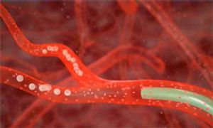 SIR-Spheres Microspheres for the Treatment of Liver Mets From CRC: Results of the SIRFLOX Trial Eagerly Anticipated