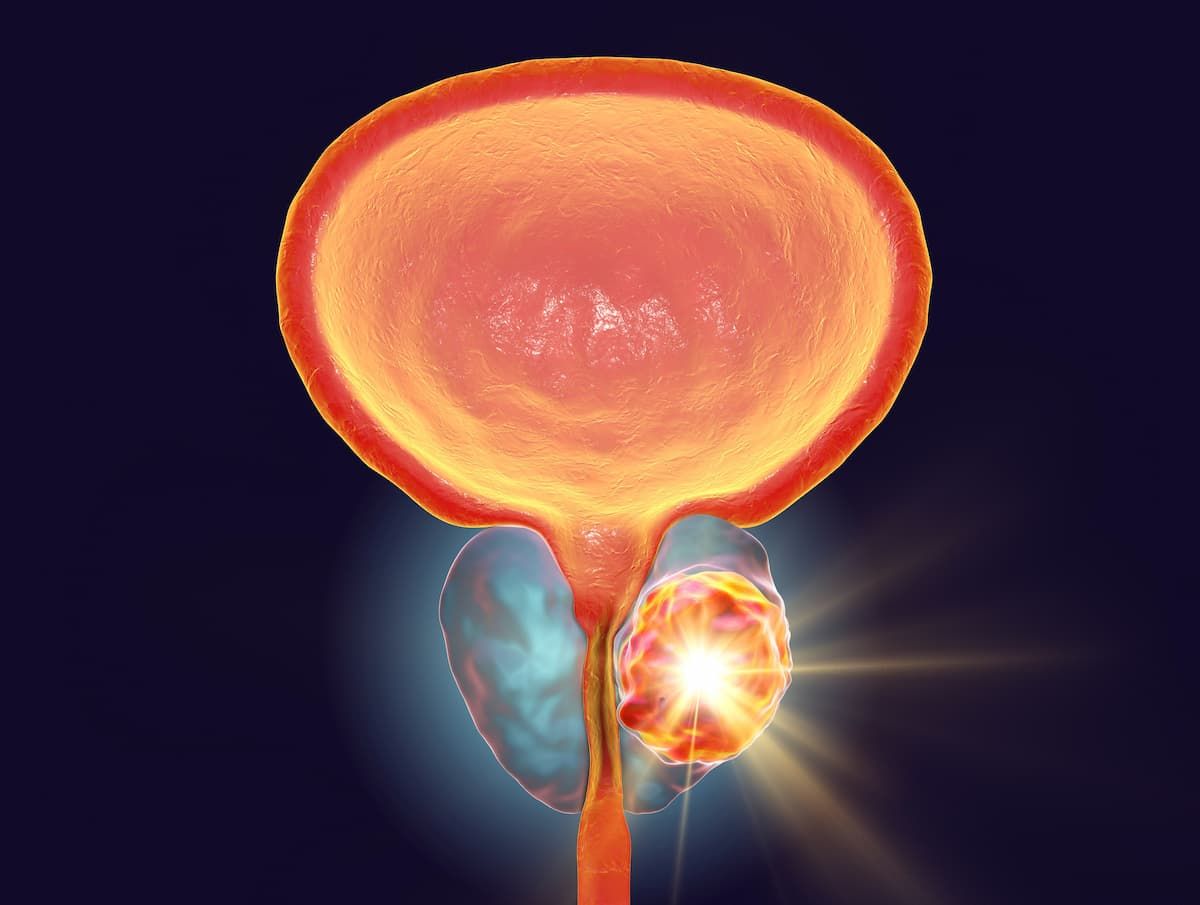 Talazoparib Plus Enzalutamide Cuts Progression Risk by 52% in HRR–Altered mCSPC