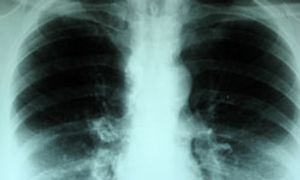 Frontline Treatment Considerations in Non-Small Cell Lung Cancer