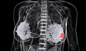 2013 Breast Cancer Symposium Highlights Results With Eribulin