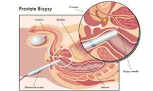 Targeted Biopsies Detect More High-Risk Prostate Cancers Than Standard Biopsies