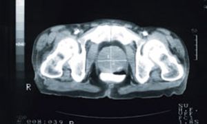 Expert Perspectives: Androgen-Deprivation Therapy in Prostate Cancer