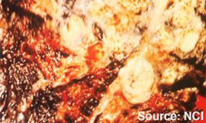 Anti-Angiogenic Therapy for the Treatment of Lung Cancer