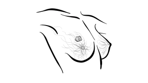 Combining Blood Tests Improves Prediction of Breast Cancer Treatment Response 