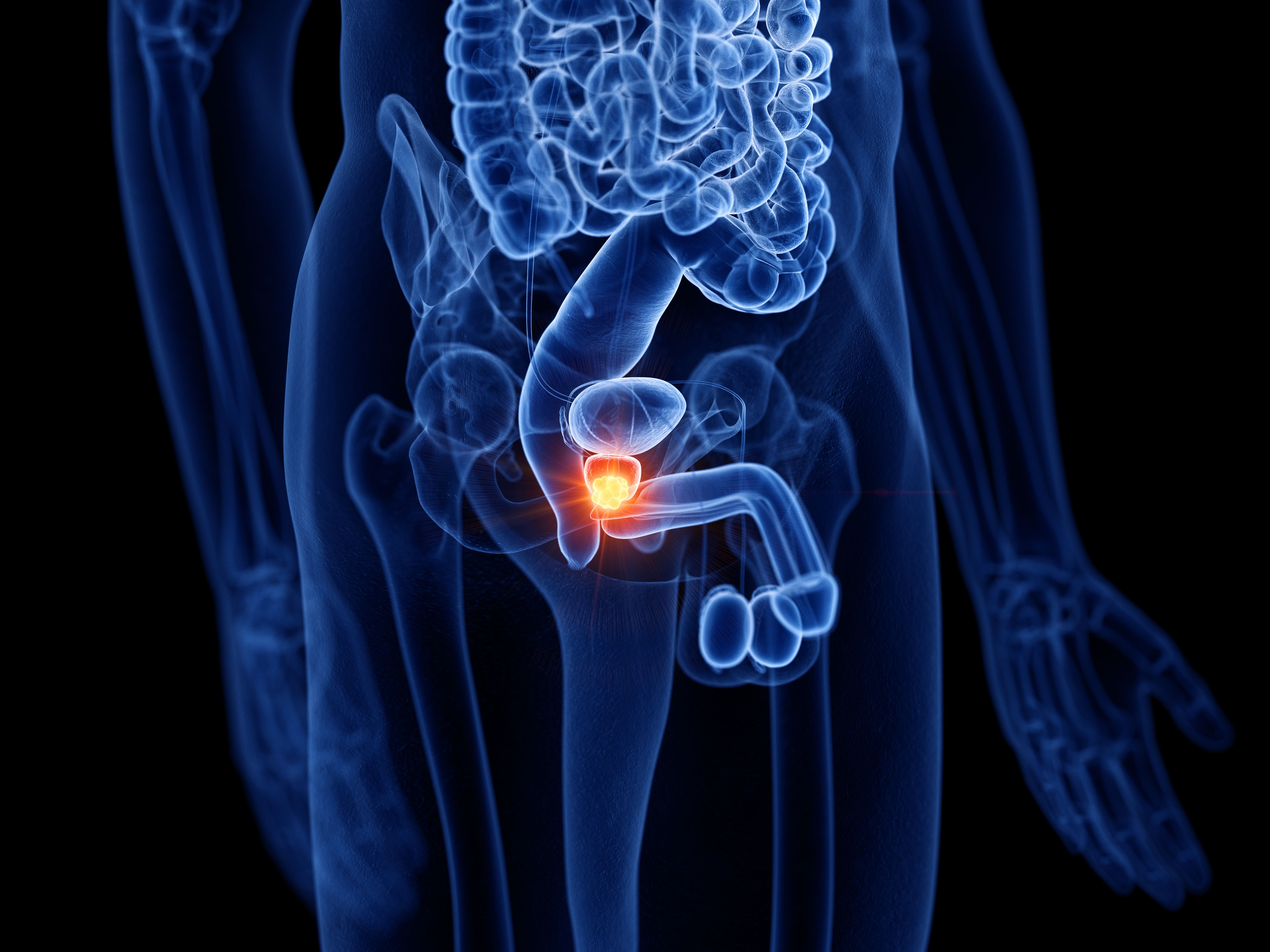 PARP Inhibitors Gain Indications in Advanced Prostate Cancer
