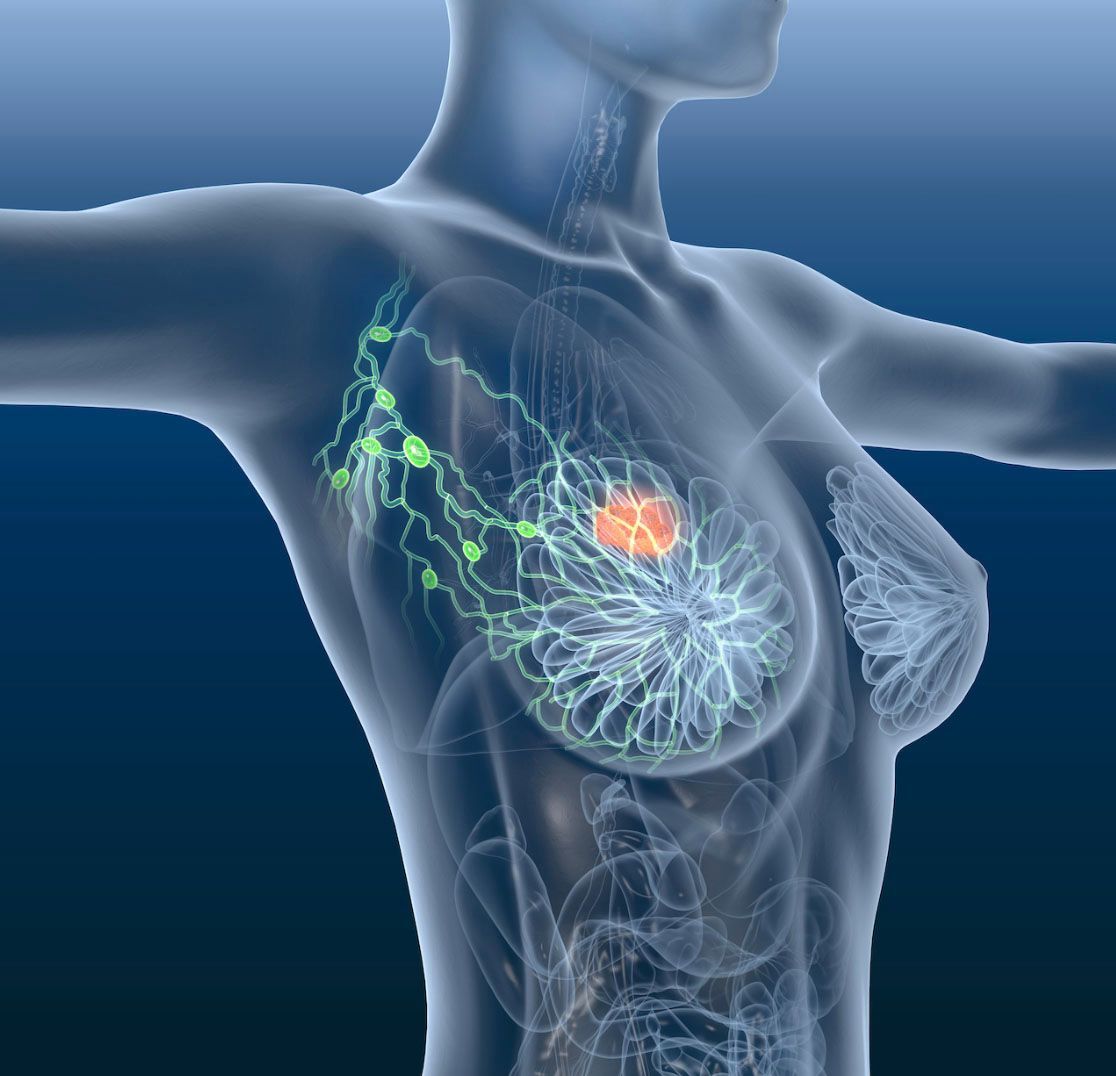 Safety of Tucatinib Triplet for HER2+ Breast Cancer Sealed in Real-World Analysis | Targeted Oncology - Immunotherapy, Biomarkers, and Cancer Pathways Safety of Tucatinib Triplet for HER2+ Breast Cancer Sealed in Real-World Analysis | Targeted Oncology - Immunotherapy, Biomarkers, and Cancer Pathways