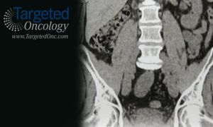 Improving Surveillance for Hepatocellular Carcinoma