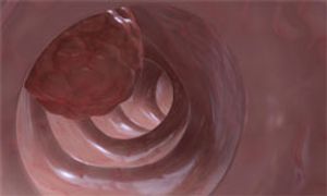 Additional OS and PFS Benefits With Aflibercept in Post-Hoc VELOUR Analysis