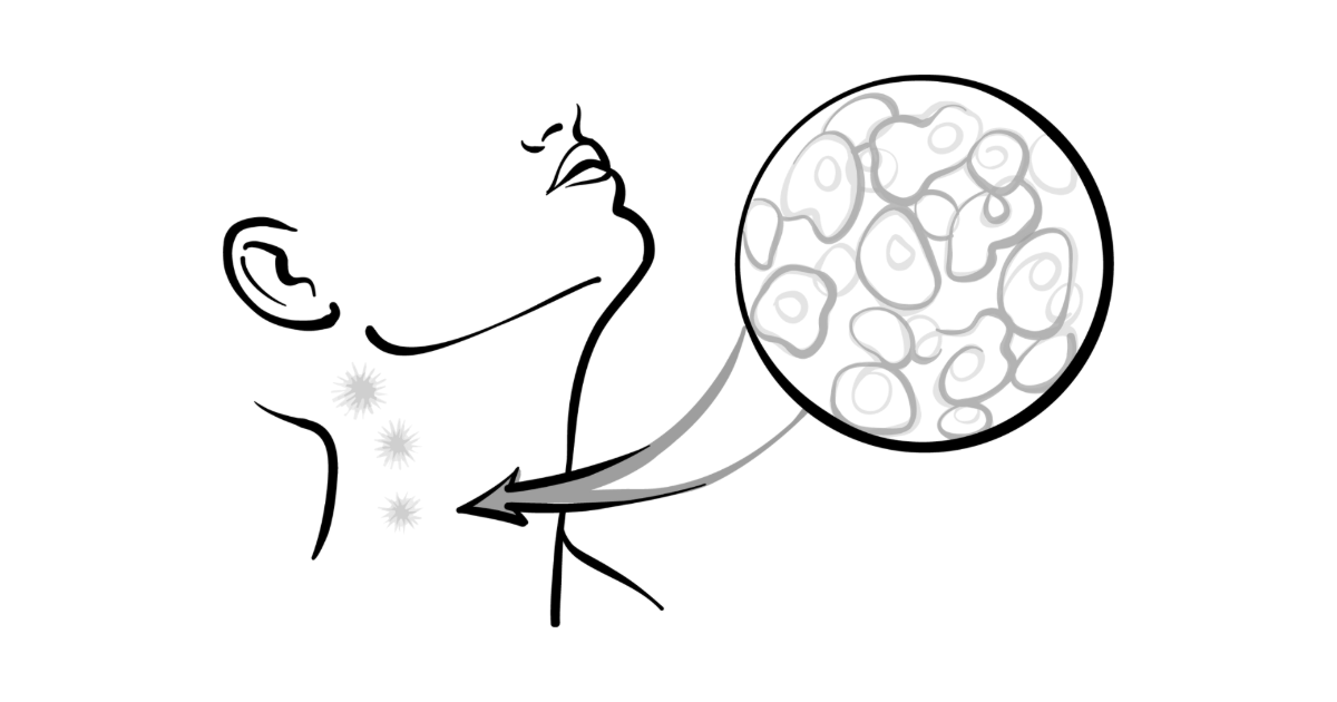 CAR T Toxicity Differences Seen in Transplant-Ineligible LBCL CAR T Toxicity Differences Seen in Transplant-Ineligible LBCL