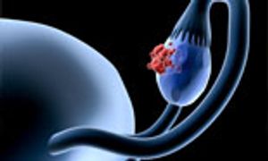 Early Research Under Way to Improve Drug Delivery in Ovarian Cancer