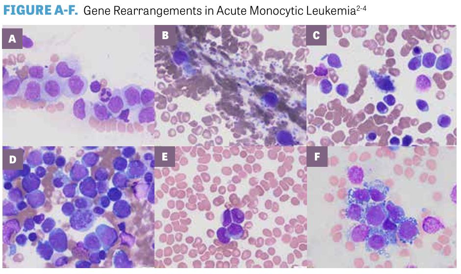 Red Cell Inclusions Aml Defining Advances in the WHO Classification for AML