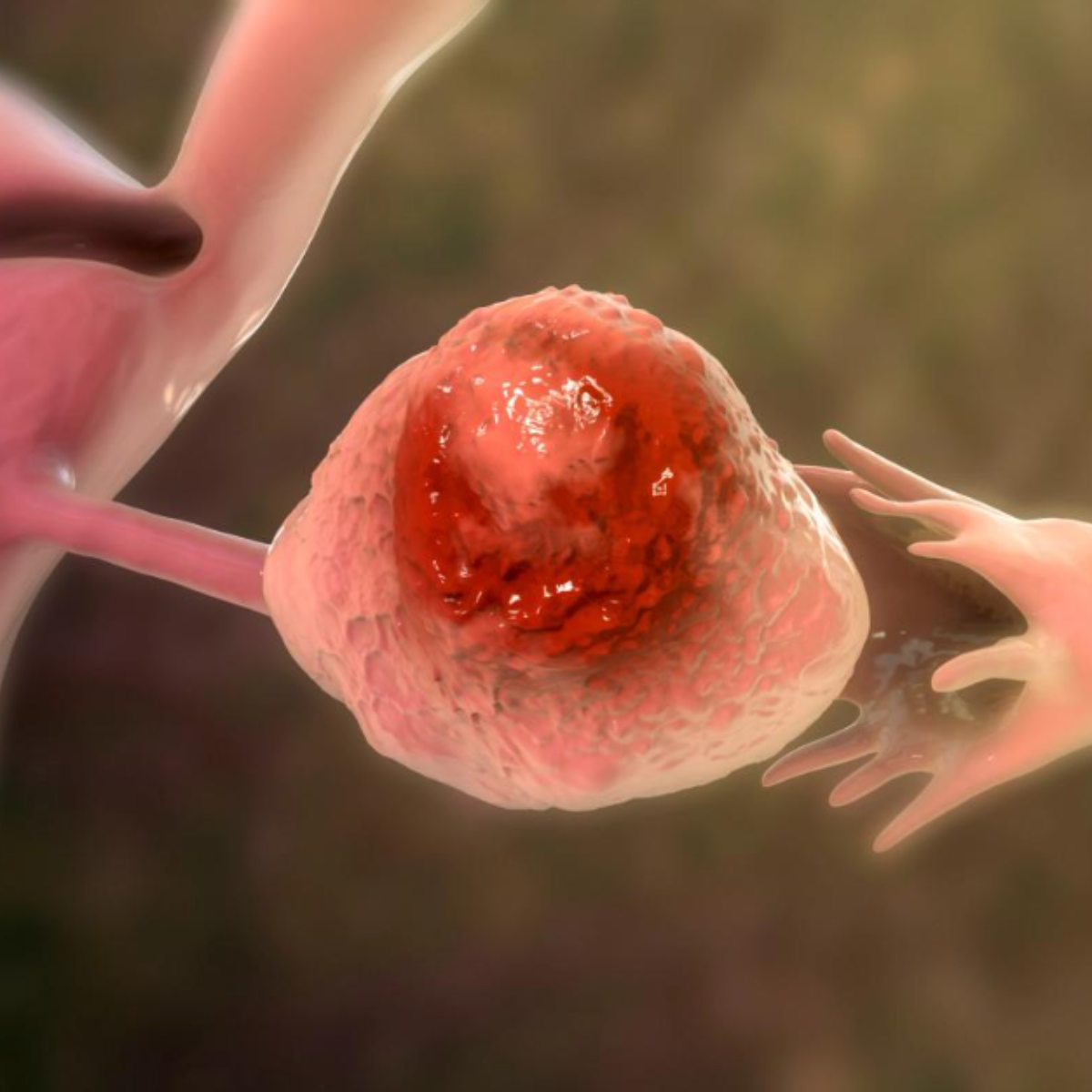 Pembrolizumab Improves PFS in Recurrent Ovarian Cancer