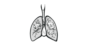 Lung Cancer Guideline Review Boosts Confidence in EBUS-Based Biopsy