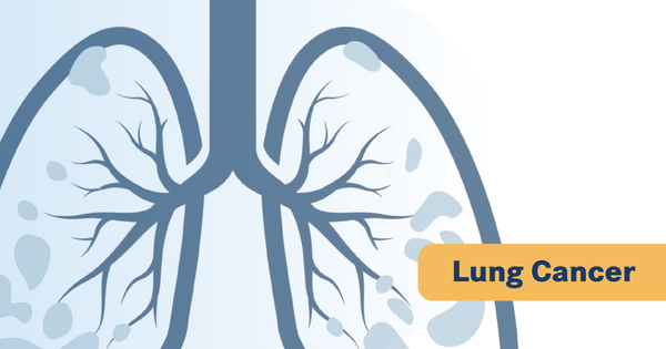 Adding Thoracic Radiotherapy to Chemo-Immunotherapy Fails in SCLC