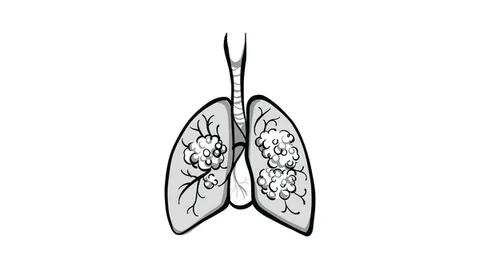 Long-term benefits of amibantamab continue in post-platinum NSCLC