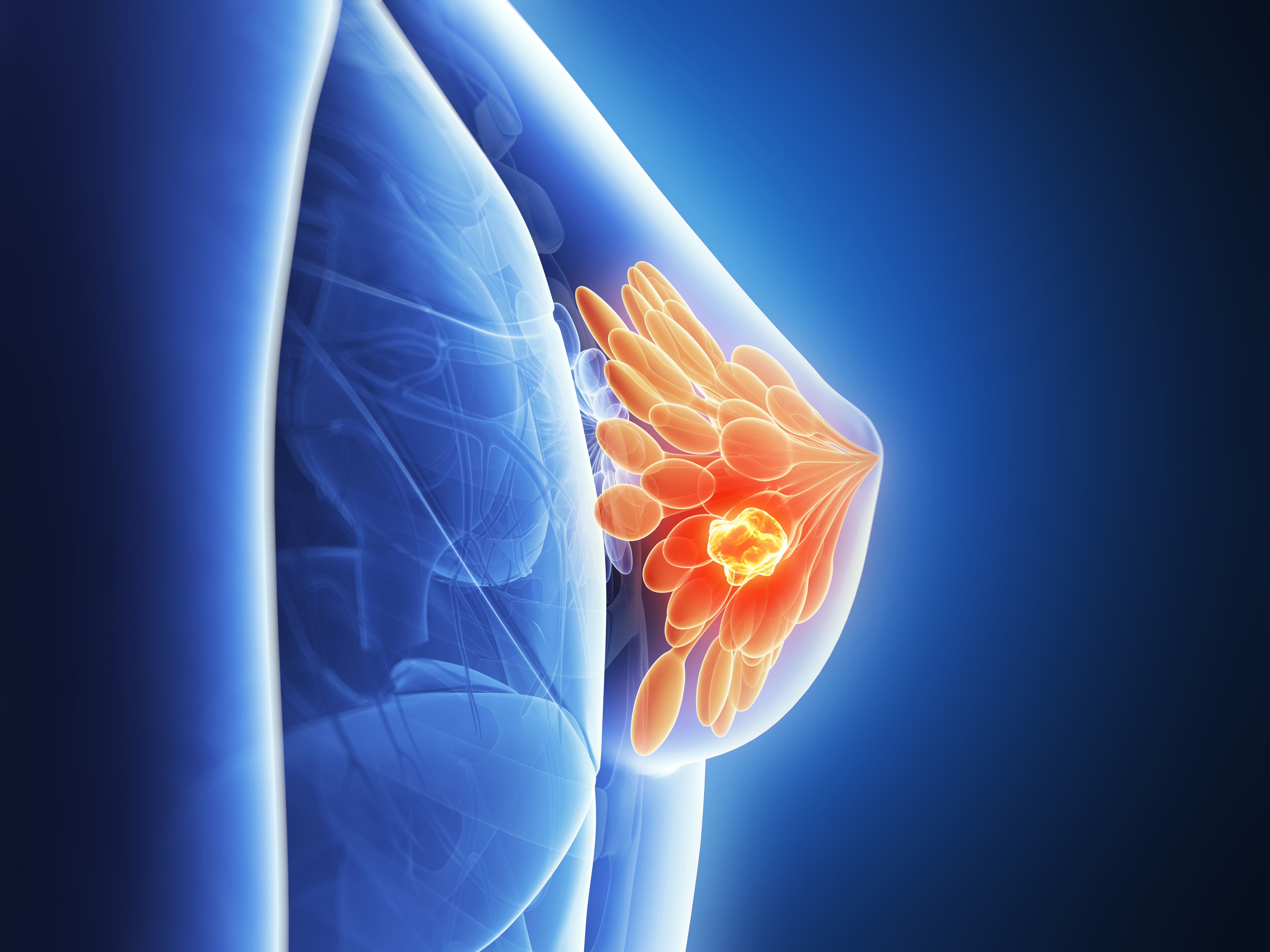 Resultados consistentes en cáncer de mama avanzado con bajo nivel de HER2 utilizando T-DXd