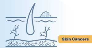 NST-628 Shows Early Promise in NRAS/BRAF+ Melanoma, Other Solid Tumors