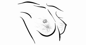 The Future of MRD in Breast Cancer Treatment