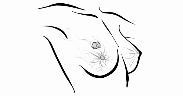 Nadunolimab Misses Efficacy Mark in TNBC, Despite Strong OS