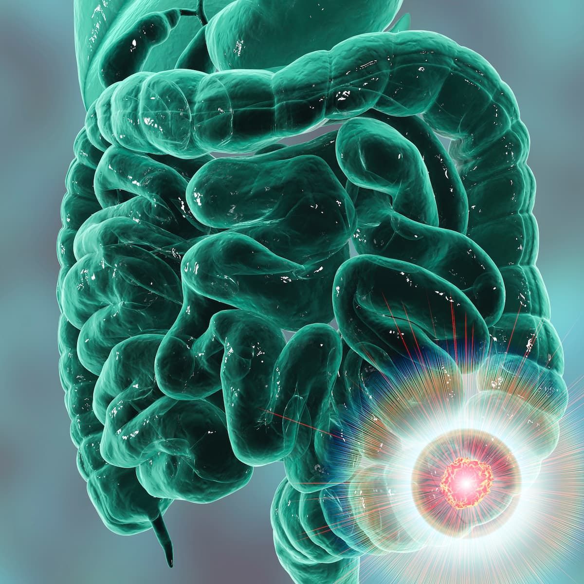glp-1 bowel obstruction class action in louisiana Louisiana GLP-1 Lawyer glp-1 bowel obstruction class action in louisiana Louisiana GLP-1 Lawyer