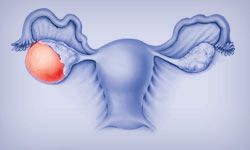 Peritoneal cancer neoplasm, Cancerul ovarian. Simptome și factori de risc