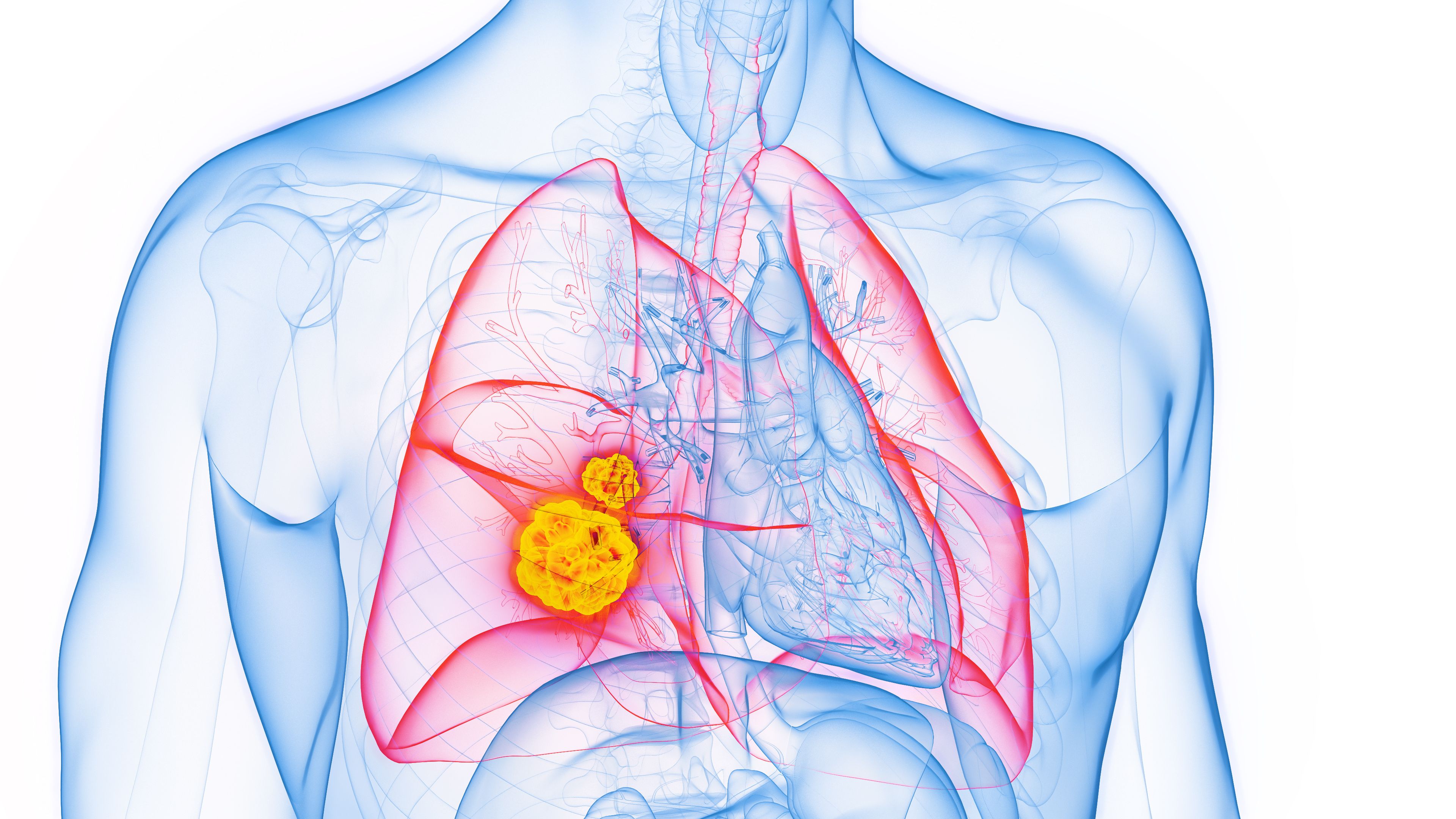 Nivolumab supera la supervivencia libre de complicaciones frente a la quimioterapia en el cáncer de pulmón de células no pequeñas