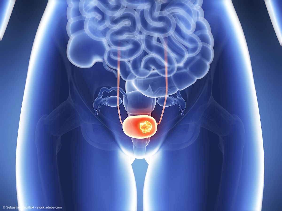 3d rendered illustration - bladder cancer | Image Credit: © Sebastian Kaulitzki - stock.adobe.com