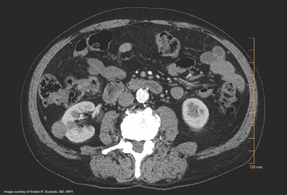 Figure. Incidentally detected small renal mass, right kidney, in an diabetic, hypertensive male with mild renal dysfunction considering his management options. Source: Kristen R. Scarpato, MD, MPH