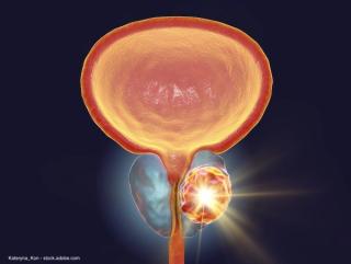 Dr. Freedland on role of cabazitaxel in prostate cancer paradigm