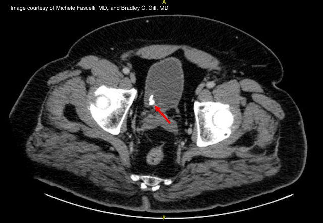 Challenging cases in urology Persistent ureteral stone in a 76