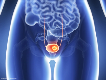 medical depiction of a blue xray of bladder cancer