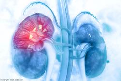 Next steps for burst wave lithotripsy in kidney stones