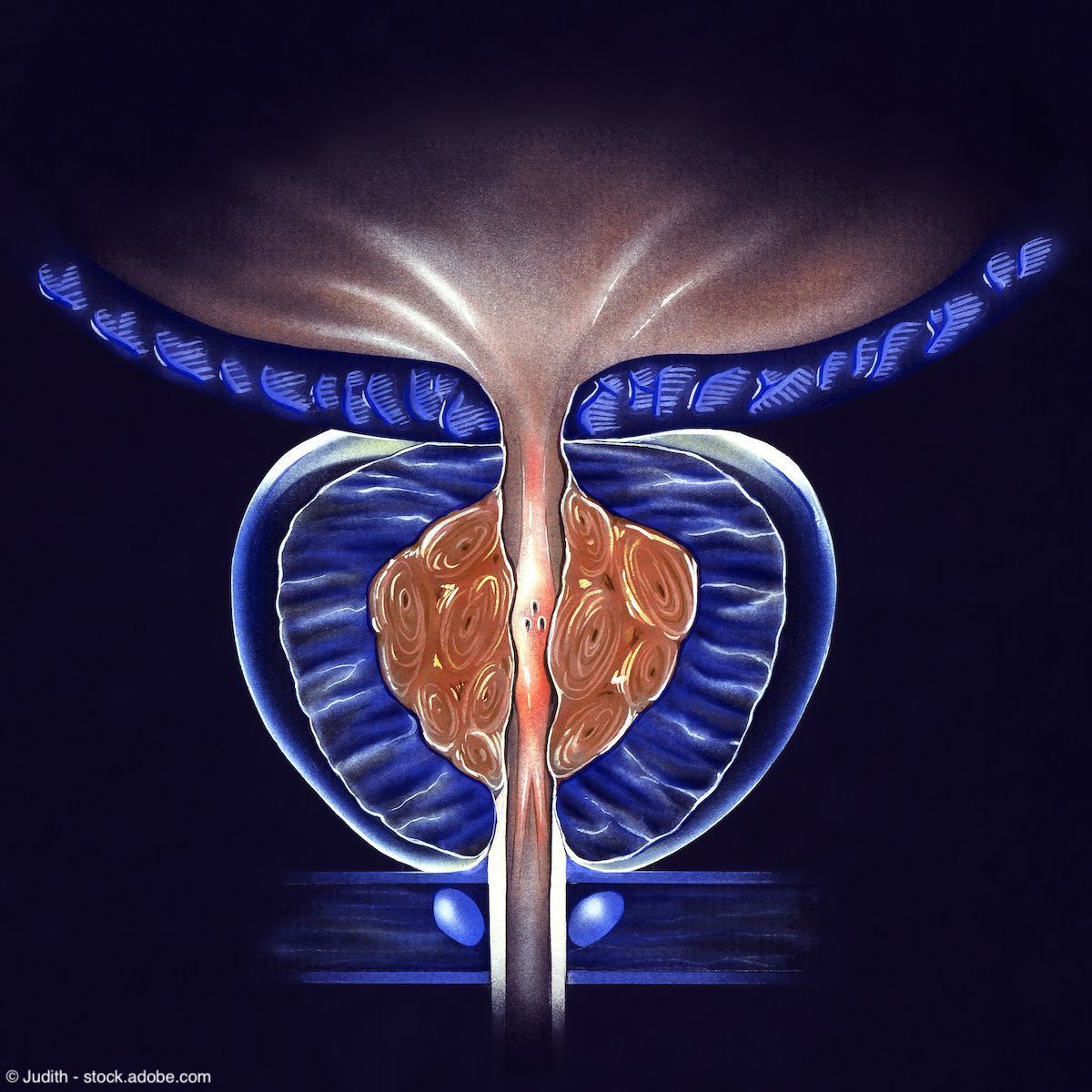 Prostate Gland - (BPH) Benign Prostatic Hyperplasia | Image Credit: © Judith - stock.adobe.com