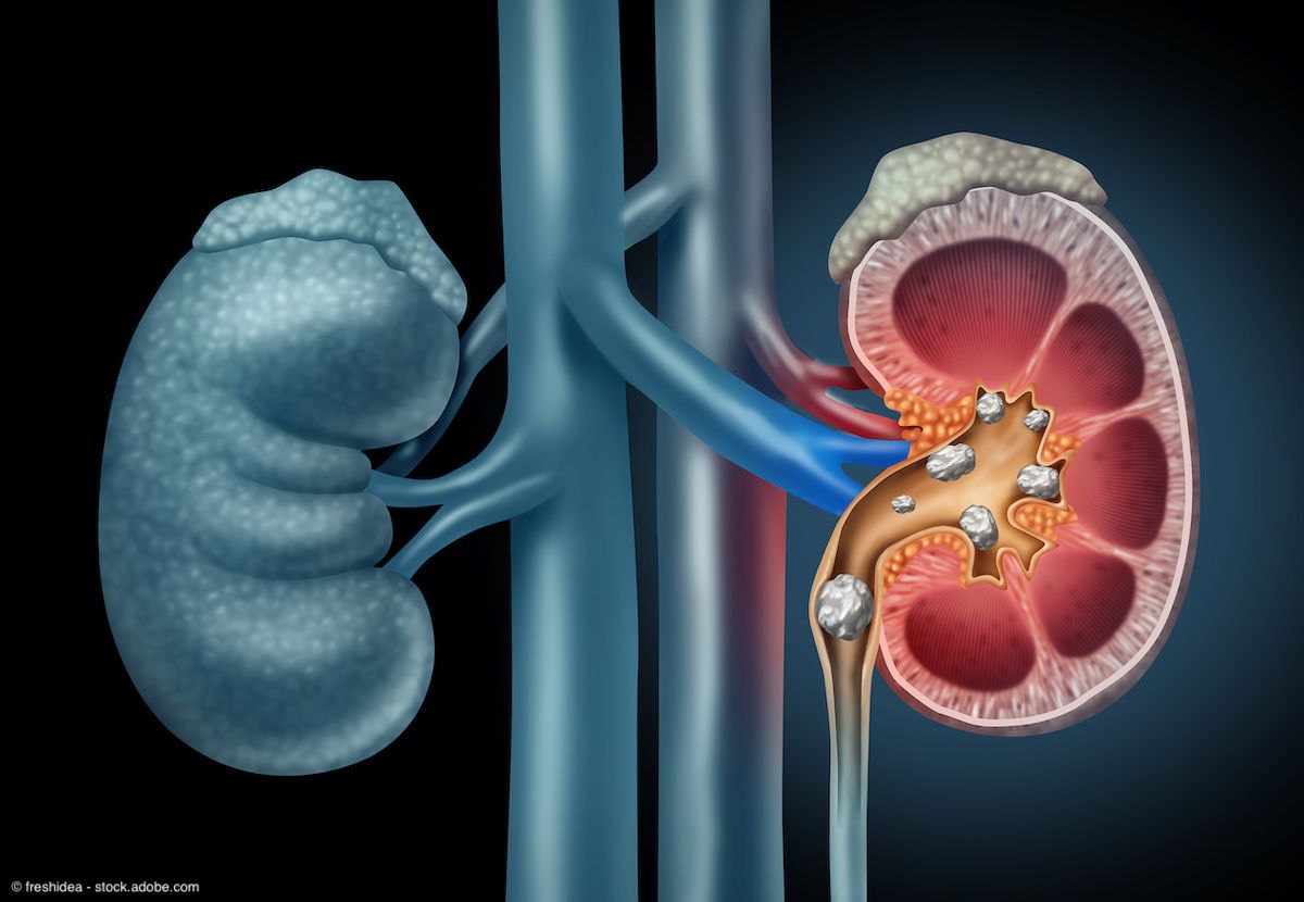 Top 10 kidney stone stories in 2024