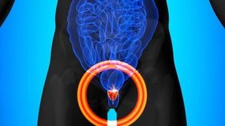 Dr. Wagaskar explains the obesity paradox in prostate cancer