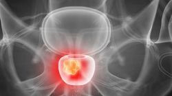 Analysis: Feasible to explore RT plus next-gen hormonal therapy in phase 3 high-risk local prostate cancer trials