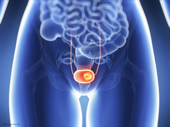 medical depiction of bladder cancer