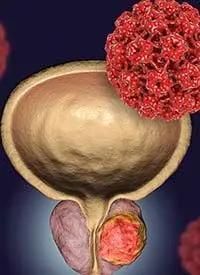 The goal of the study was to assess whether a moderate increase in daily radiation treatment could achieve similar control of prostate cancer as conventional fractionation but over a shorter duration of treatment.