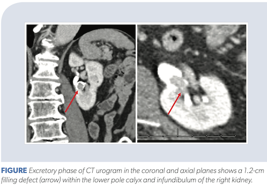 Management Of Utuc Using A Kidney Sparing Approach