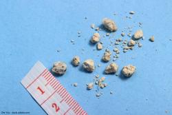 Study estimates 12-month kidney stone incidence in the US at 2.1%