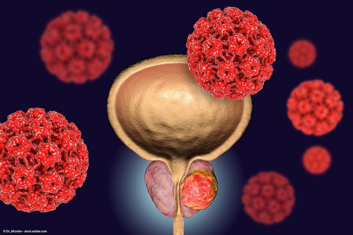 Conceptual image for viral ethiology of prostate cancer. 3D illustration showing Human Papilloma Viruses HPV infecting prostate gland which develops cancerous tumor | Image Credit: © Dr_Microbe - stock.adobe.com  