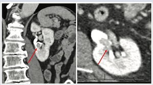 Management of UTUC using a kidney-sparing approach