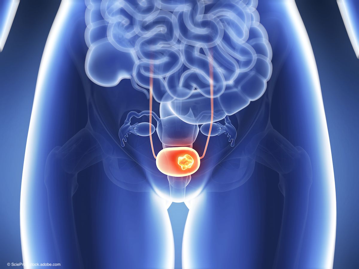 3d rendered illustration of bladder cancer | Image Credit: © SciePro - stock.adobe.com