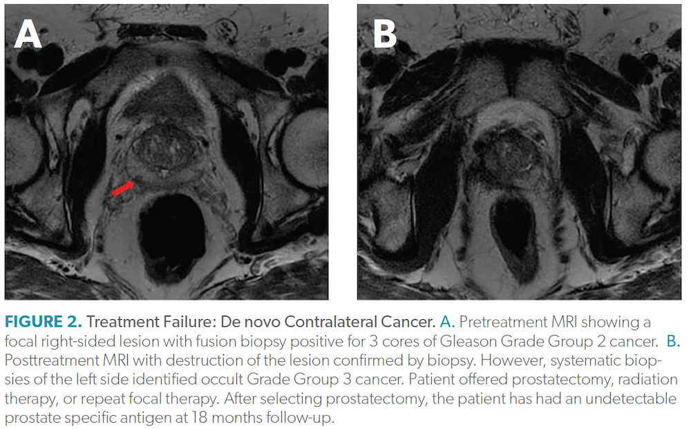 Management Of Recurrent Prostate Cancer After Focal Therapy