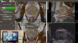MRI/TRUS fusion-guided biopsy using UroNav