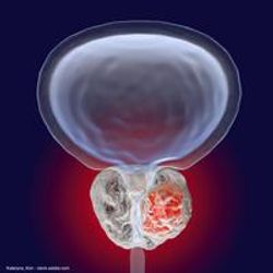 FDA authorizes trial of novel PSMA-PET imaging diagnostic in prostate cancer